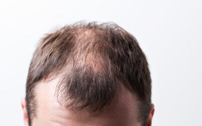 Caída del cabello: Verdades y mitos