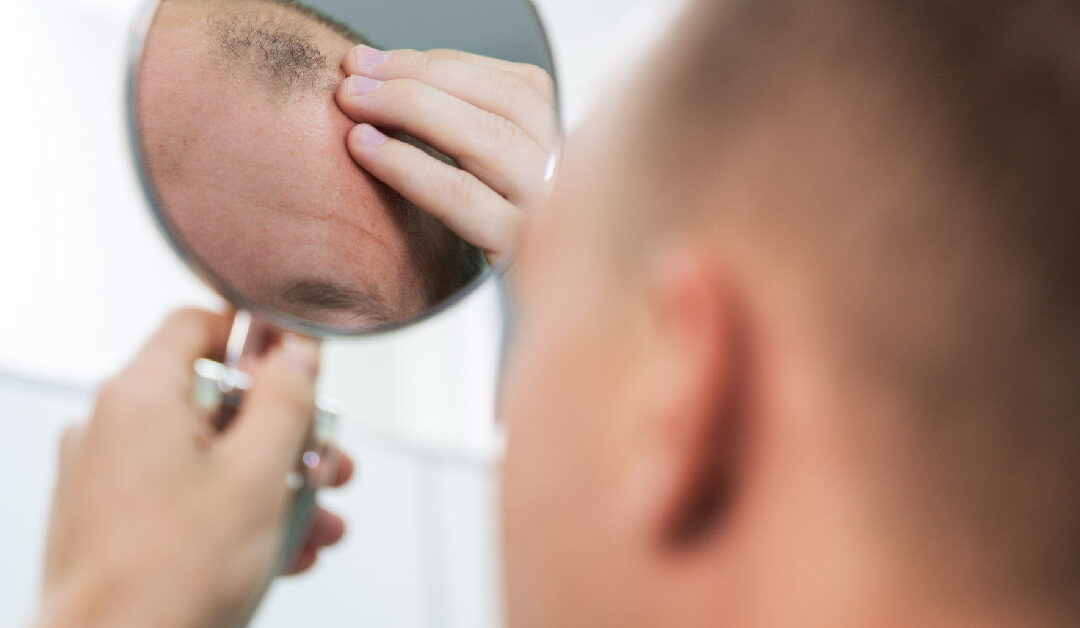 TEST: Descubre tu tipo de Alopecia