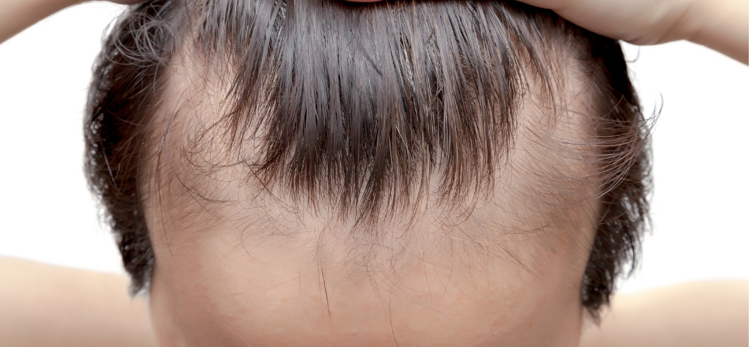 Alopecia: Causas, tratamiento y otras preguntas frecuentes